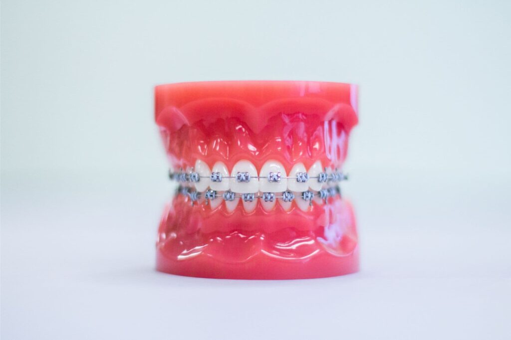 How Can I Prevent Tooth and Gum Issues While Wearing Braces?